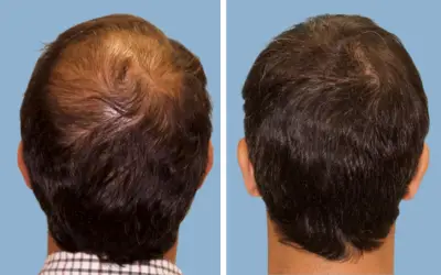 Before and After